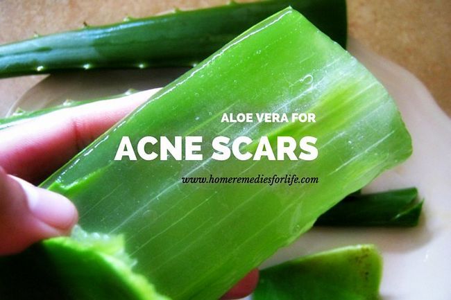 Aloe vera para las cicatrices del acné