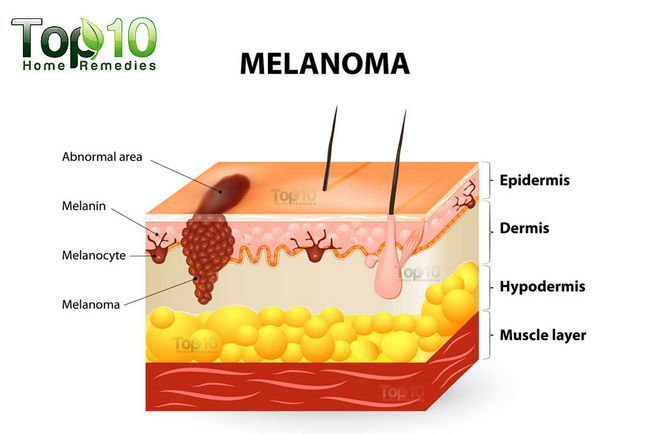 El melanoma (cáncer de piel) los síntomas no se debe pasar por alto