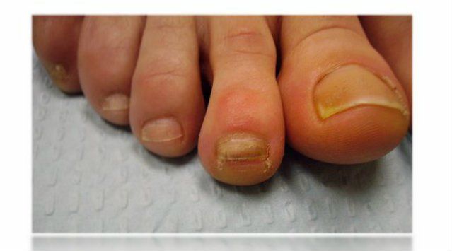 Síntomas de trauma de uñas, las causas y el tratamiento?