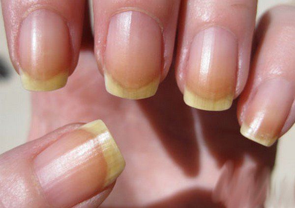 Razones para decoloración de las uñas - remedios para la decoloración de las uñas