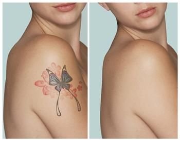 Métodos de eliminación de tatuajes Top