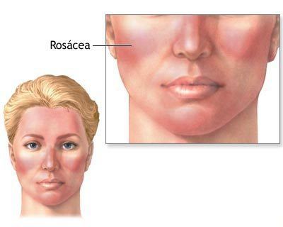 ¿Qué es el acné rosácea? Los remedios caseros para el acné adulto