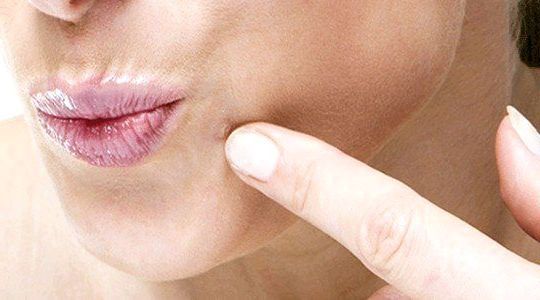 10 remedios caseros para las verrugas faciales