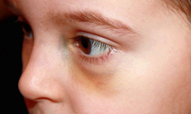 15 Remedios caseros para deshacerse de Negro de ojos