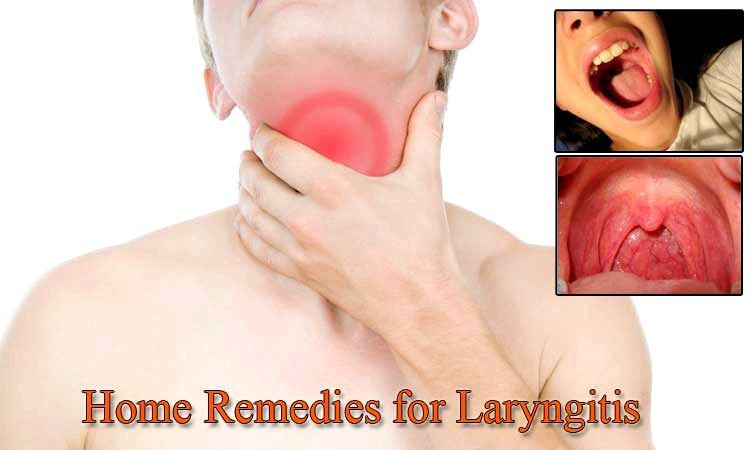 25 Remedios caseros para la laringitis