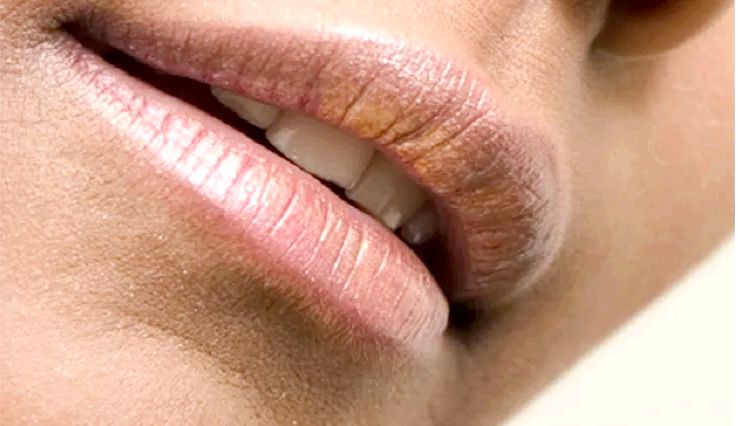 30 Remedios caseros para Black Lips