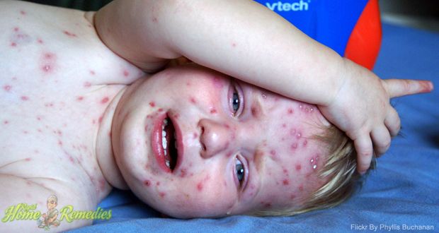 18 remedios caseros simples para la varicela