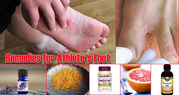 17 remedios caseros para el pie de atleta