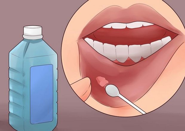 17 remedios naturales para deshacerse de las úlceras de la boca