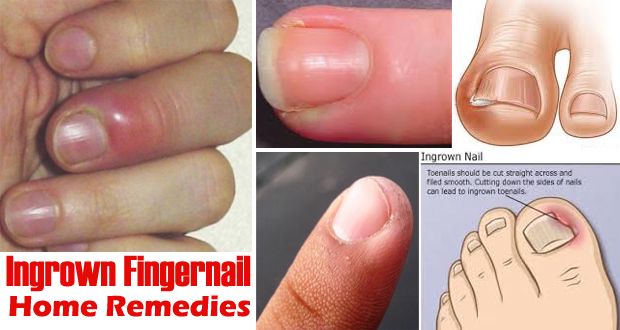 ¿Cómo deshacerse de las uñas encarnadas