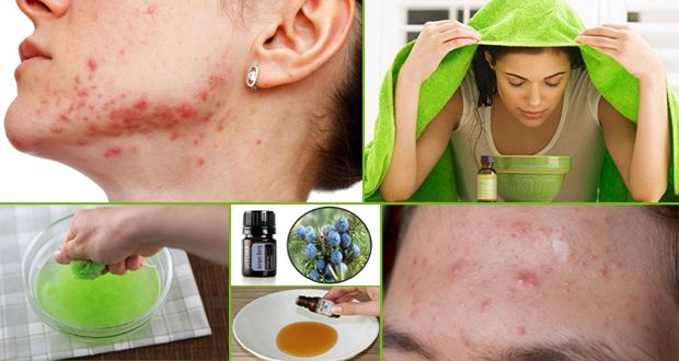 Los remedios naturales para deshacerse de acné quístico rápida
