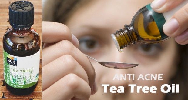 Aceite de árbol de té para el acné
