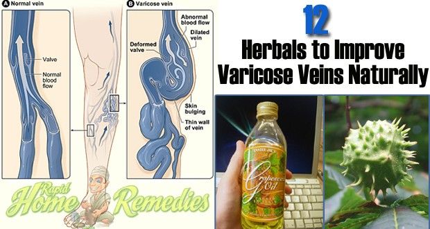 Top 12 remedios caseros a base de hierbas para las venas varicosas