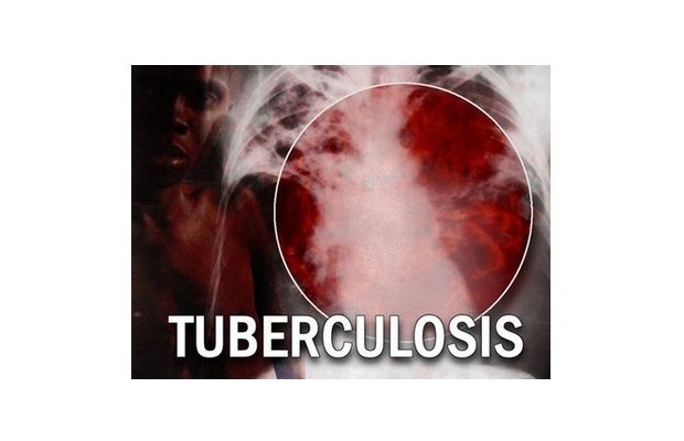 10 remedios caseros eficaces para la tuberculosis (TB)