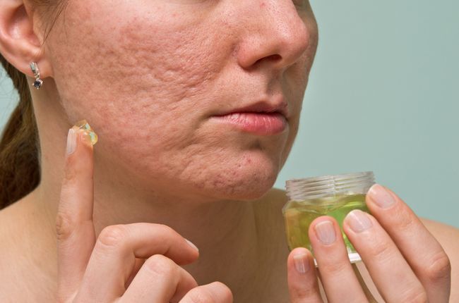 10 Super Clever Formas naturales para eliminar las cicatrices del acné