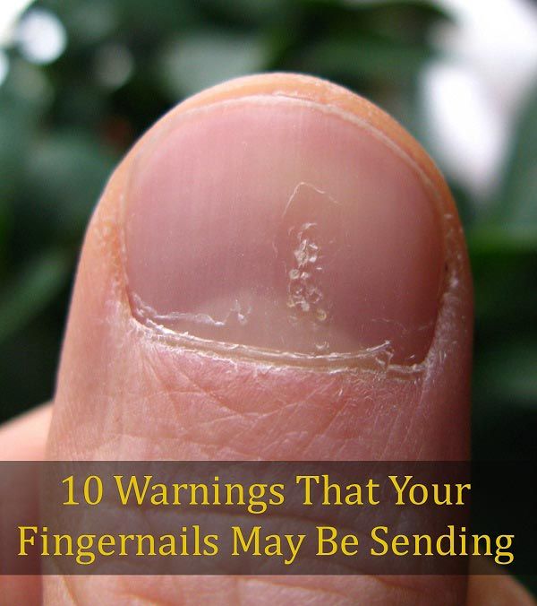 10 Las advertencias de que las uñas pueden ser envían
