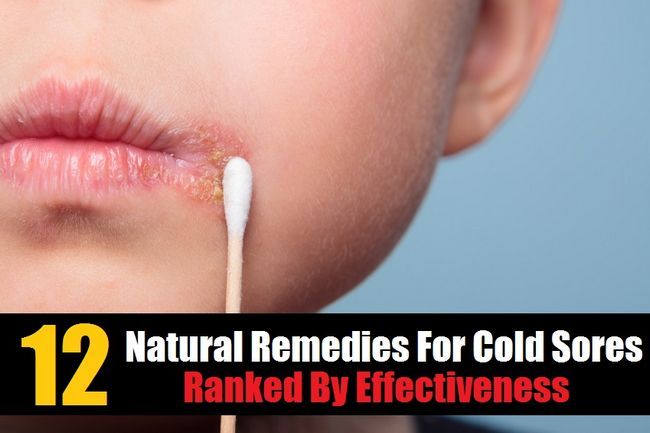 12 remedios naturales para el herpes labial clasificados según Eficacia
