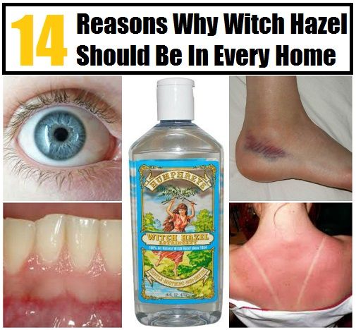 14 razones por las Witch Hazel debe estar en cada hogar
