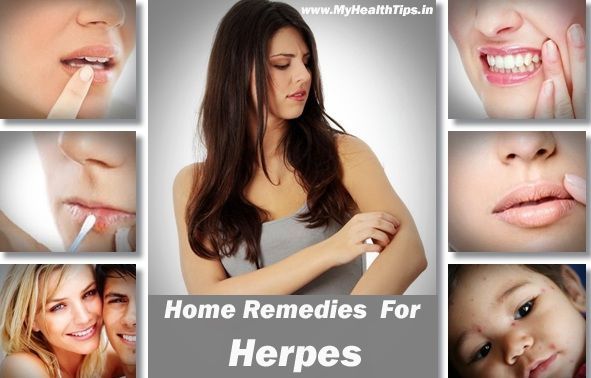 Remedios caseros eficaces para el herpes
