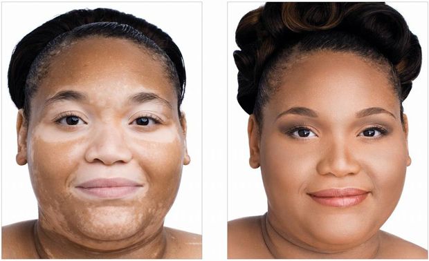 18 remedios caseros rápidos para el vitiligo