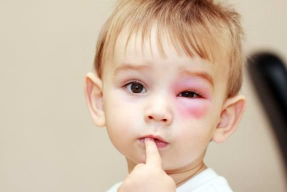 Tratamiento Bee Sting Remedios caseros