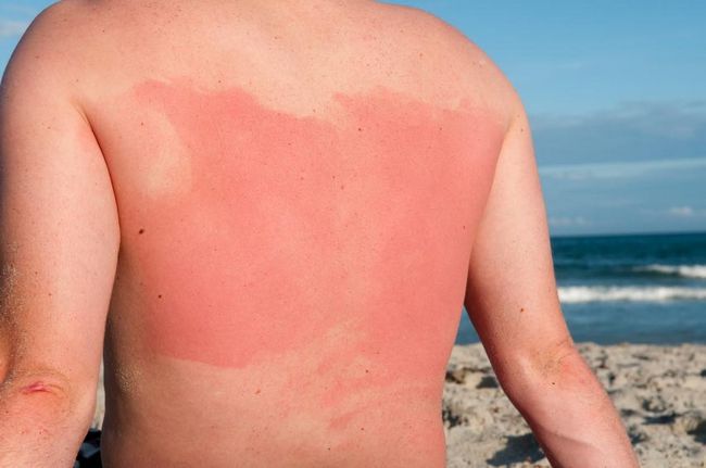 9 más eficaces remedios caseros para curar una quemadura de sol rápida