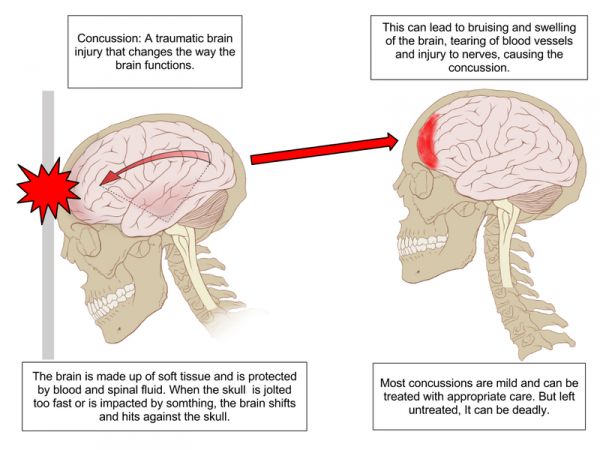 ¿Qué sucede con el cerebro durante una conmoción cerebral.
