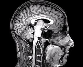 Los investigadores están dreating una herramienta que puede ayudar a predecir quién está en riesgo de problemas de memoria y la cognición.