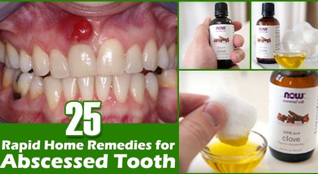 Los mejores remedios caseros para el absceso dental