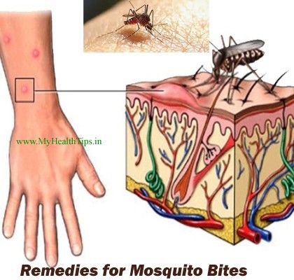 Mosquito-Bites-remedios