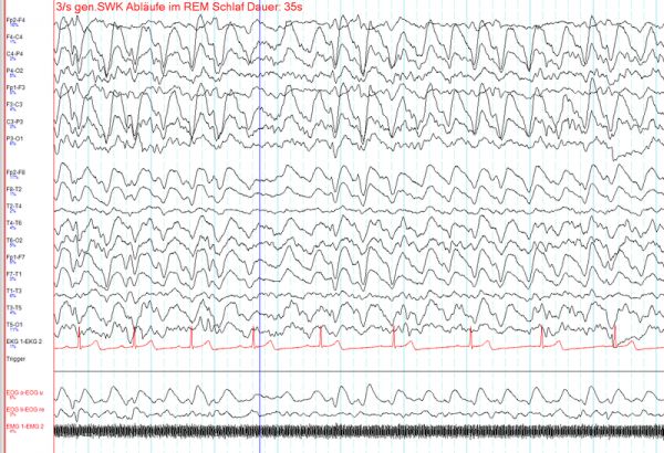 El electroencefalograma (EEG) puede yeild una nueva prueba para el TDAH.