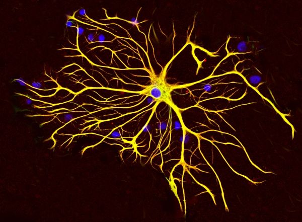 Las células del cerebro se regeneran después de un derrame cerebral: estudio