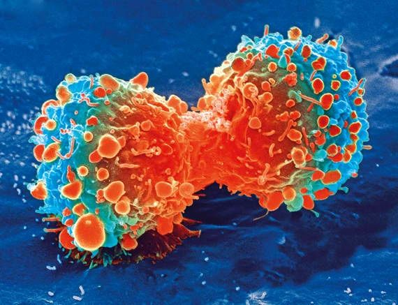 Clasificación del cáncer debe incluir tipos genéticos y moleculares