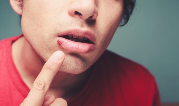 Remedios dolor frío para tratamiento de herpes labial