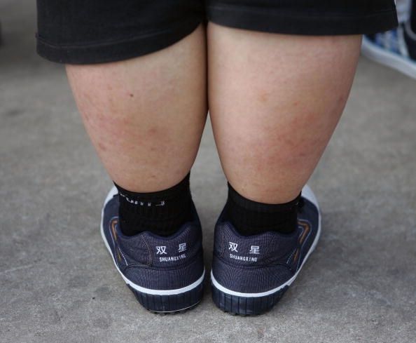 La mayoría de los casos de obesidad son una cuestión de dieta y ejercicio, pero un niño se ha encontrado que tienen un gen defectuoso para la hormona leptina.