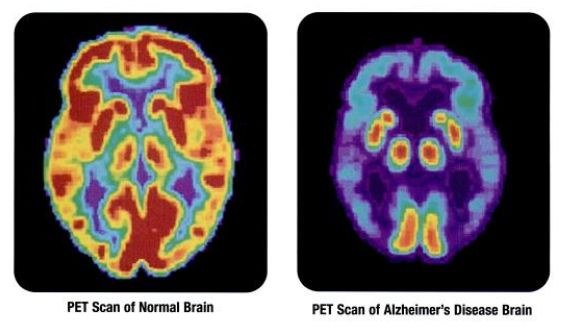 La PET del cerebro. Los investigadores están encontrando una manera de utilizar la PET para diagnosticar la encefalopatía traumática crónica.