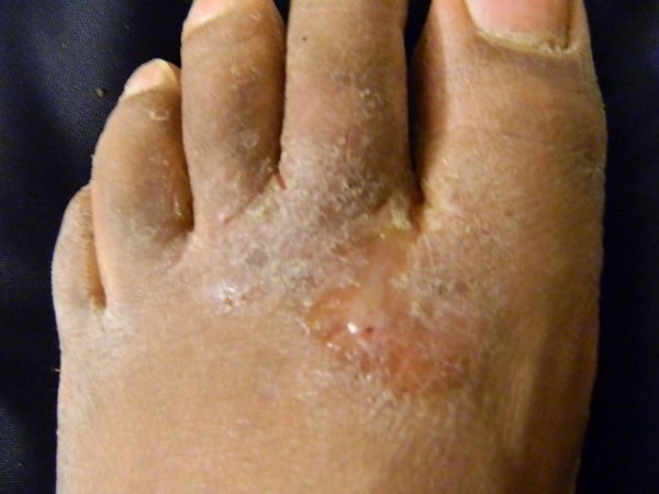 Atleta`s foot is a painful and itchy condition on your feet