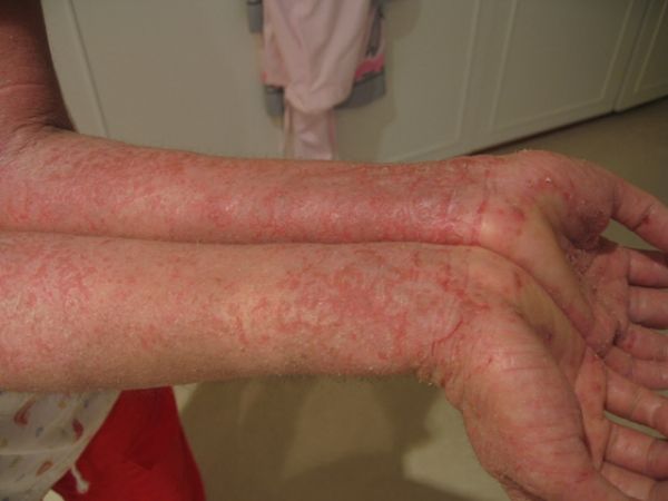 eczema en los brazos