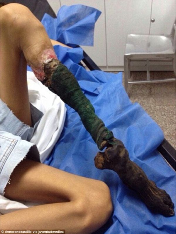 Chica`s rotten and necrotic leg