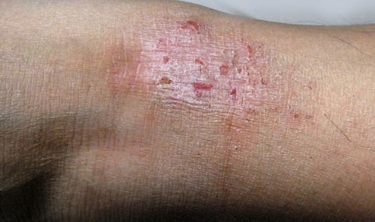 Remedios caseros para las erupciones del cuerpo y Alergias Tratamiento