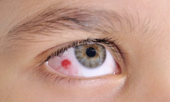 Remedios caseros para los ojos Tratamiento de la infección