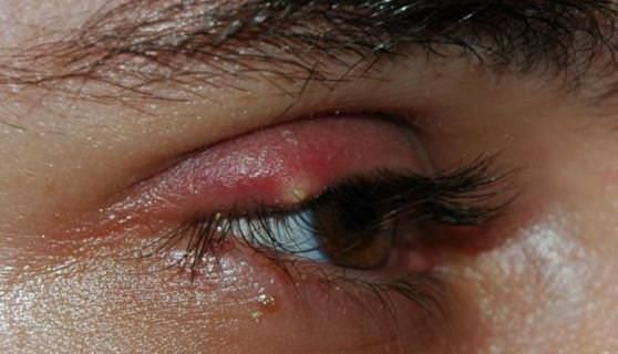 Remedios caseros para los ojos Tratamiento del orzuelo