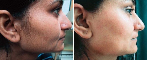 Remedios caseros Facial Depilación