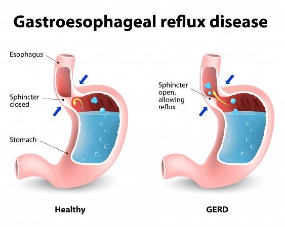 http: imágenes / Home-remedios-For-Gastro-esofágico-reflujo-Enfermedad-GERD.jpg