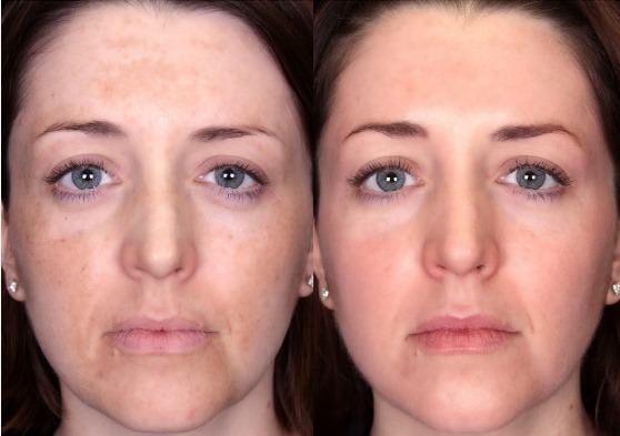 Remedios caseros para el melasma tratamiento y curación