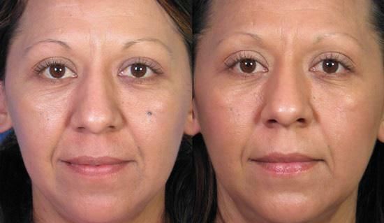 Remedios caseros para la Eliminación Moles