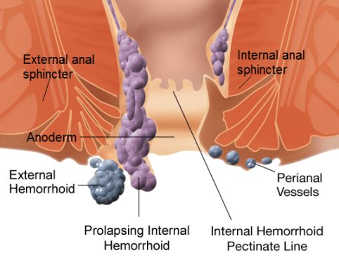 Remedios caseros para Hemorroides Tratamiento Piles Naturalmente
