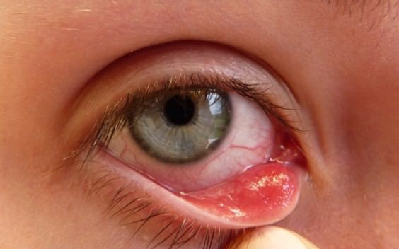 Remedios caseros para Pink Eye Treatment deshacerse de Pink Eye