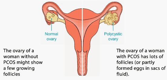 Remedios caseros para el de ovario poliquístico (SOP) de tratamiento natural