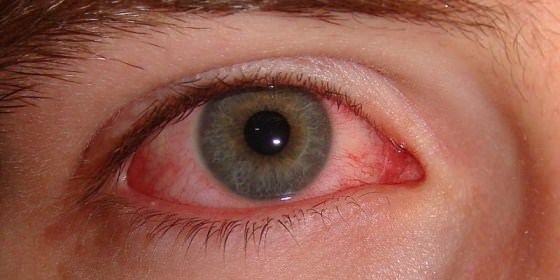 Remedios caseros para los ojos rojos tratamiento natural